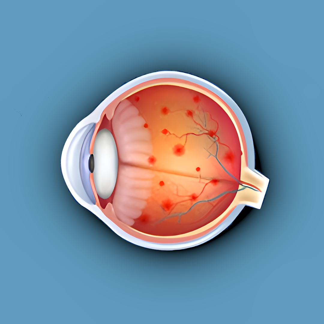 Diabetic Retinopathy