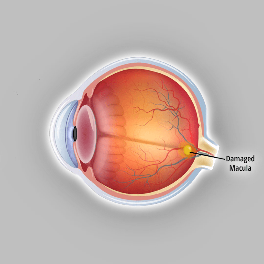 graphic illustration of macular degeneration