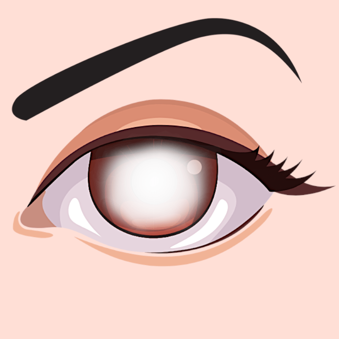 illustration of cataract