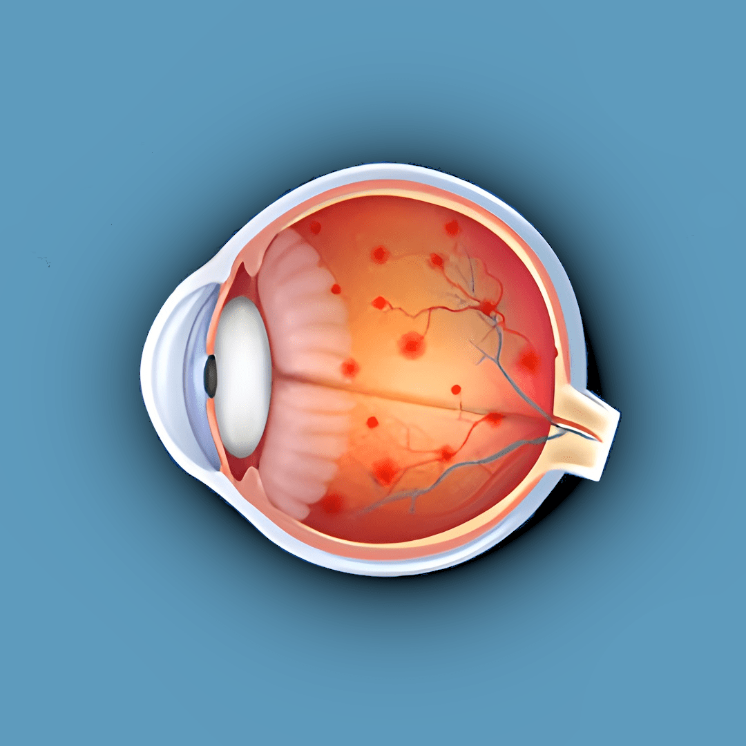 illustration of diabetic retinopathy