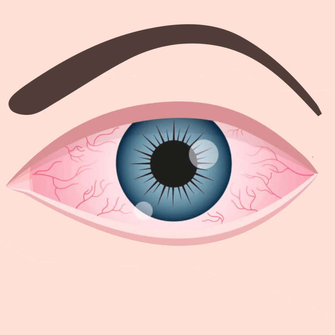 illustration of dry eye