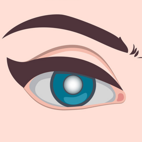 illustration of glaucoma