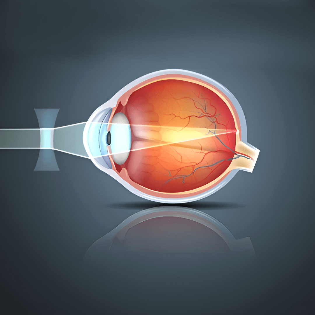illustration of myopia